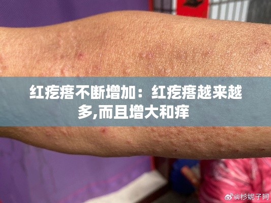 红疙瘩不断增加：红疙瘩越来越多,而且增大和痒 